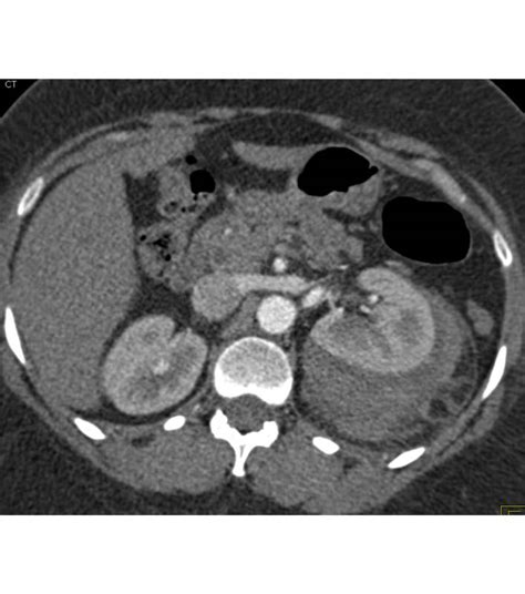 Renal Laceration With Perirenal Blood Due To Trauma Trauma Case