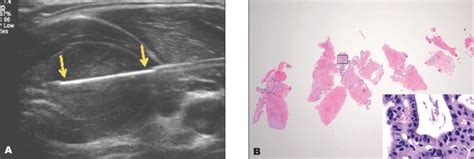 Comparison Of The Efficacy And Safety Of Ultrasound Guided Core Needle