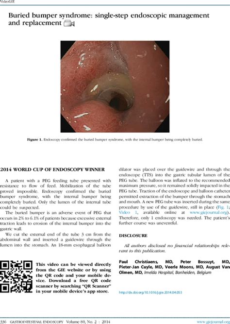Buried Bumper Syndrome Single Step Endoscopic Management And