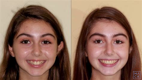Braces Before And After With Reshaping Of Front Teeth Youtube