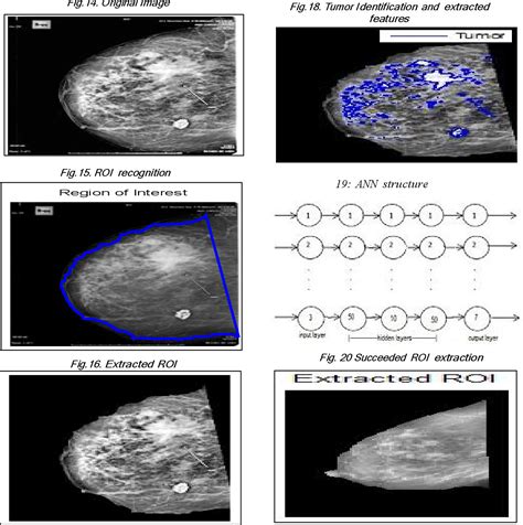 Figure 20 From Solving Mammography Problems Of Breast Cancer Detection