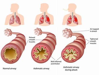 Asthma Immune System Triggers Lungs Response Antibodies