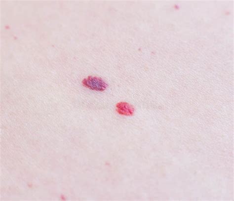 Two Red Moles On The Patient S Skin Hemangioma Macro Angioneuromas