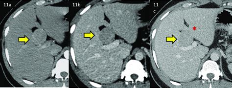 Triple Phase Cect Scan Of A Lirads 5 Observation In The Liver With Well