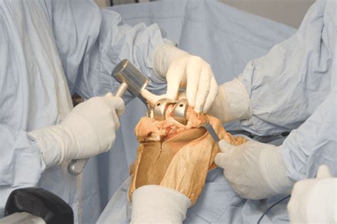 Who Are Orthopaedic Surgeons And What Do They Do — Medipulse Best