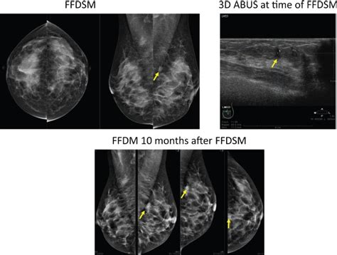 Adding 3d Automated Breast Ultrasound To Mammography Screening In Women
