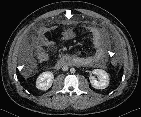 Eosinophilic Ascites A Challenging Diagnosis