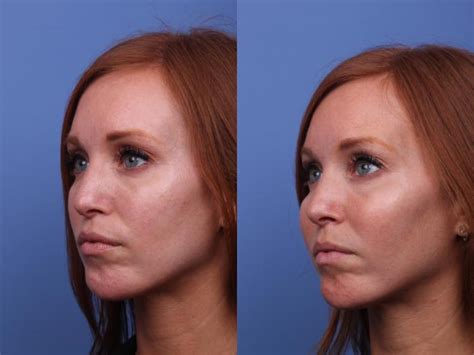 Cheek Implant Before And After Pictures Case 317 Scottsdale Az