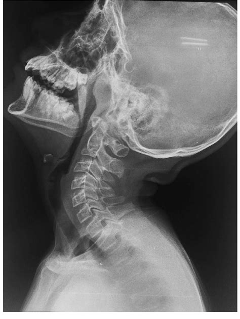 X Ray Soft Tissue Nasopharynx Lateral View Showing Moderate Degree