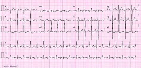 Axis deviation indicates possible presence of various conditions. Right Axis Deviation Ecg Differential - Article Blog