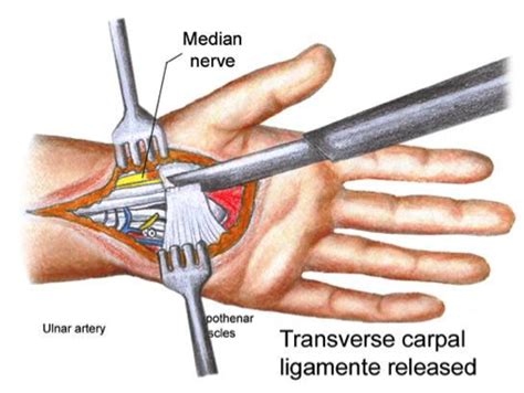 Have You Got Carpal Tunnel My Journey To Recovery And Creation Of The