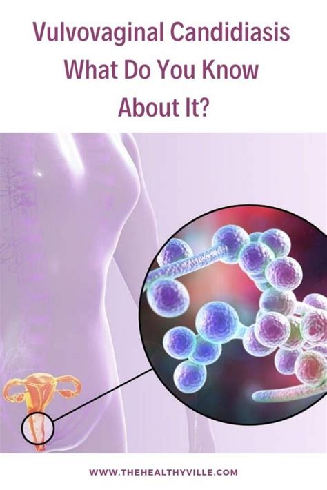Vulvovaginal Candidiasis What Do You Know About It Candida
