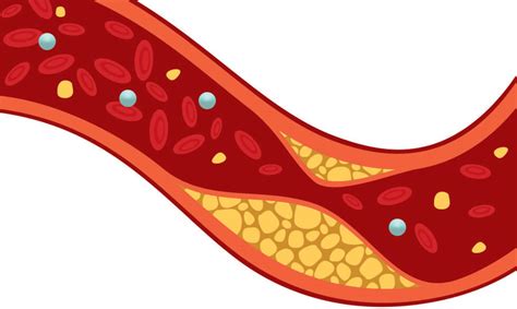 Cholesterol The Good The Bad And The Unhealthy Nih Medlineplus
