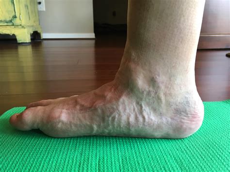 Charcot Foot The Foot And Ankle Online Journal