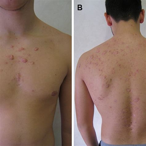 Nodular acne have a history of penetrating deep into the skin layer, causing a severe breakout at different locations of the body. a few days after starting lymecycline for nodular acne of ...