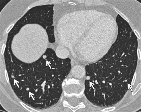 Ct Image Shows Multiple Solid Nodules Of Varying Size With Lower Zone