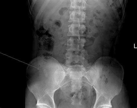 Appendiceal Faecolith A Radiological Finding Not To Be Missed Bmj