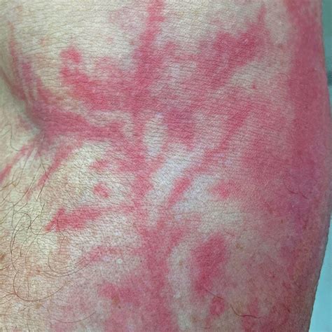 A Lichtenberg Figure In The Cubital Fossa Showing A Typical Arborizing