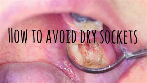 Learn a little bit about how your will cut heal to help you figure out when to relax and when you need to call the doctor. How to Avoid Dry Sockets - YouTube