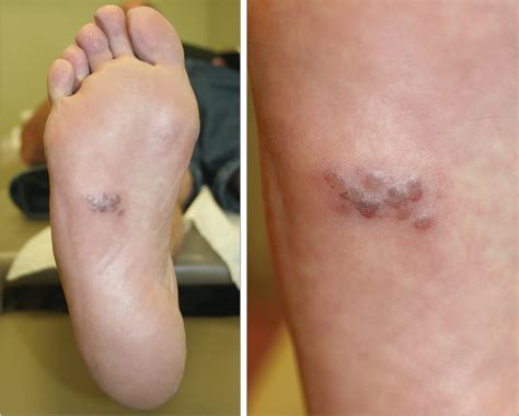 A 55 Year Old Man With A Painful Rash On The Sole Of His Foot