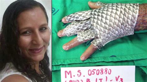 Meet First Woman To Receive Fish Skin Treatment Youtube