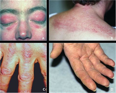 Classification Diagnosis And Management Of Idiopathic Inflammatory