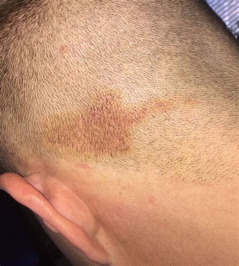 Any Advice About This Rash On My Scalp Rpsoriasis