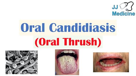 Oral Candidiasis Oral Thrush Causes Pathophysiology Signs And Symptoms Diagnosis Treatment
