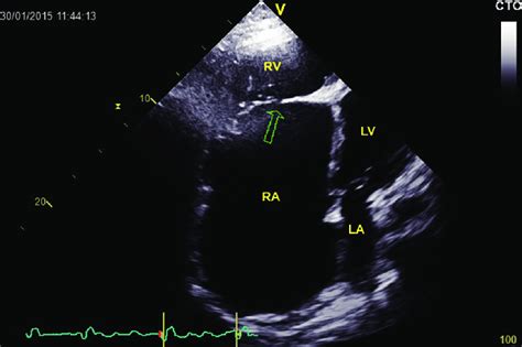 Apical Four Chamber View Dilated Right Ventricle With Apical