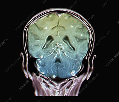Secondary Brain Cancer Mri Scan Stock Image C0388543 Science