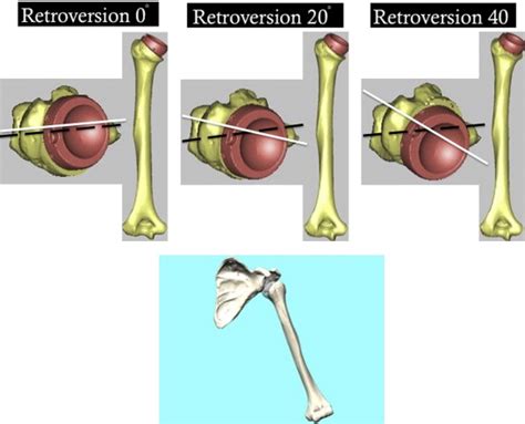 Humeral Component Retroversion In Reverse Total Shoulder Arthroplasty
