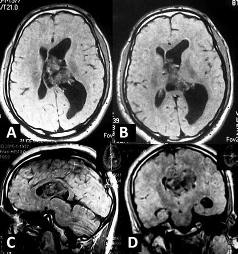 A D First Preoperative Brain Magnetic Resonance Imaging Showing