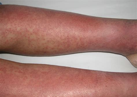 Drug Rash With Eosinophilia And Systemic Symptoms Dress Syndrome