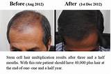 Pictures of Stem Cell Treatment For Hair Loss Side Effects