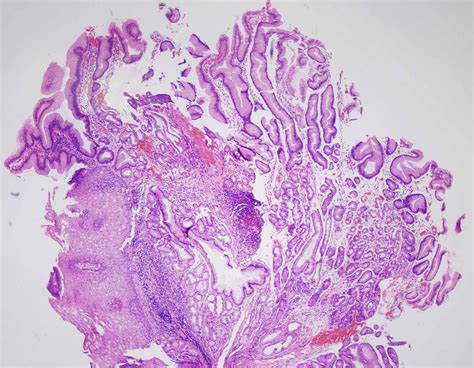 Cureus An Unusual Case Of Esophageal Hyperplastic Polyp With Free