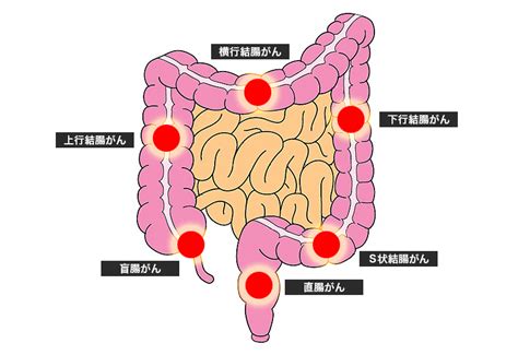 大腸癌手術の合併症について q7 大腸癌の手術後にはいろいろな合併症が起こり得るとの説明を受けました。 詳しく教えてください。 肛門括約筋温存の可否 q8 直腸癌で永久人工肛門になるといわれました。 大腸ポリープと大腸がん | くるめ病院