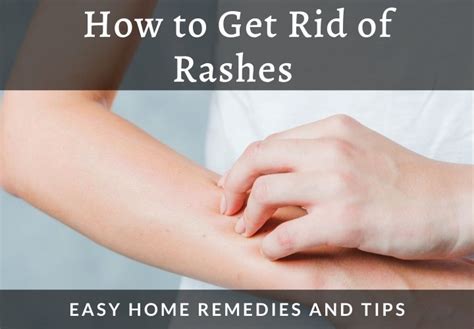 How To Get Rid Of Rashes Easy Home Remedies And Tips