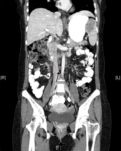 The Chest Abdomen Pelvis Computerized Tomography Image Showing