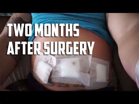 Two Months After Hernia Surgery Recovery Update Youtube