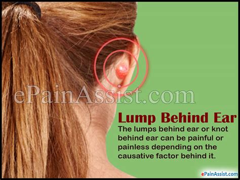 Bump On Top Of Ear Cartilage Pictures Photos