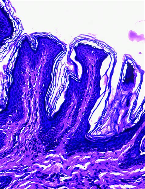 Hyperkeratosis Mild Acanthosis Papillomatosis And Hyperpigmentation