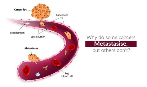 Why Do Some Cancers Metastasis But Others Donâ€™t Cancer Healer Center