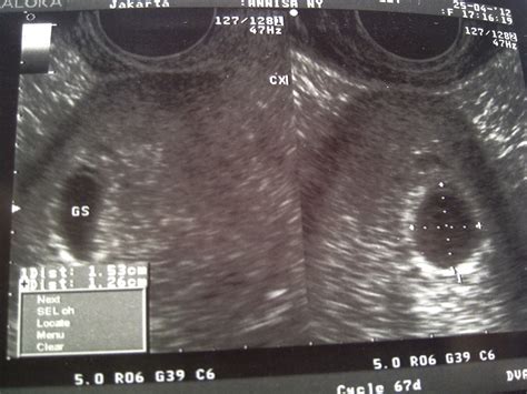 Pemeriksaan ultrasonografi (usg) adalah hal yang sangat dianjurkan untuk perempuan hamil. My Miracle Pregnancy: Desember 2012