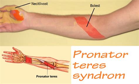 Pronator Teres Syndrome Ultrasound