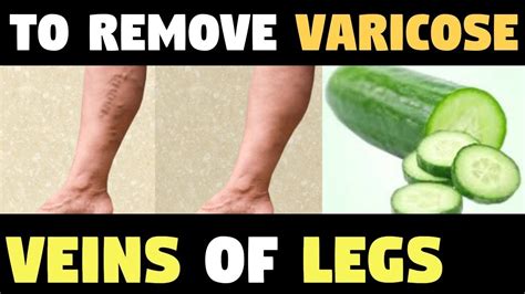 A Dermatologist Showed Me These Home Remedies To Remove Varicose Veins Of The Legs Youtube