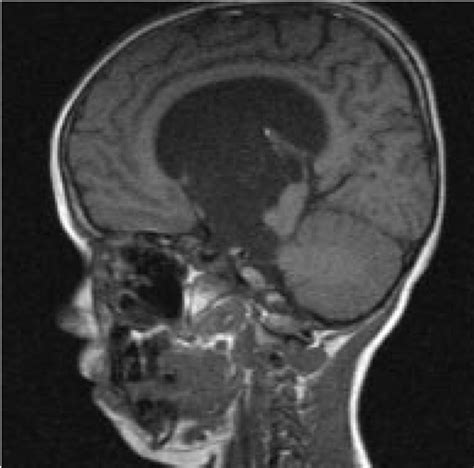 Suprasellar Arachnoid Cyst With Mild Hydrocephalus Accompanying A