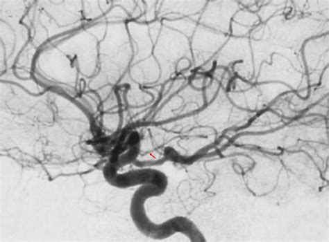 Arteria Choroidea Anterior Ars Neurochirurgica