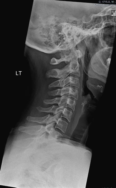 Normal Lateral Cervical Spine Radiograph Radiology Case