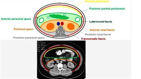 Radiology Essentials 105 Sectional Anatomy Of Retroperitoneal Spaces