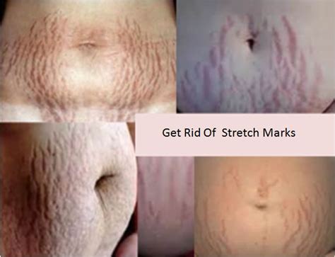 White Stretch Marks Are Usually Less Apparent Than Red Stretch Marks